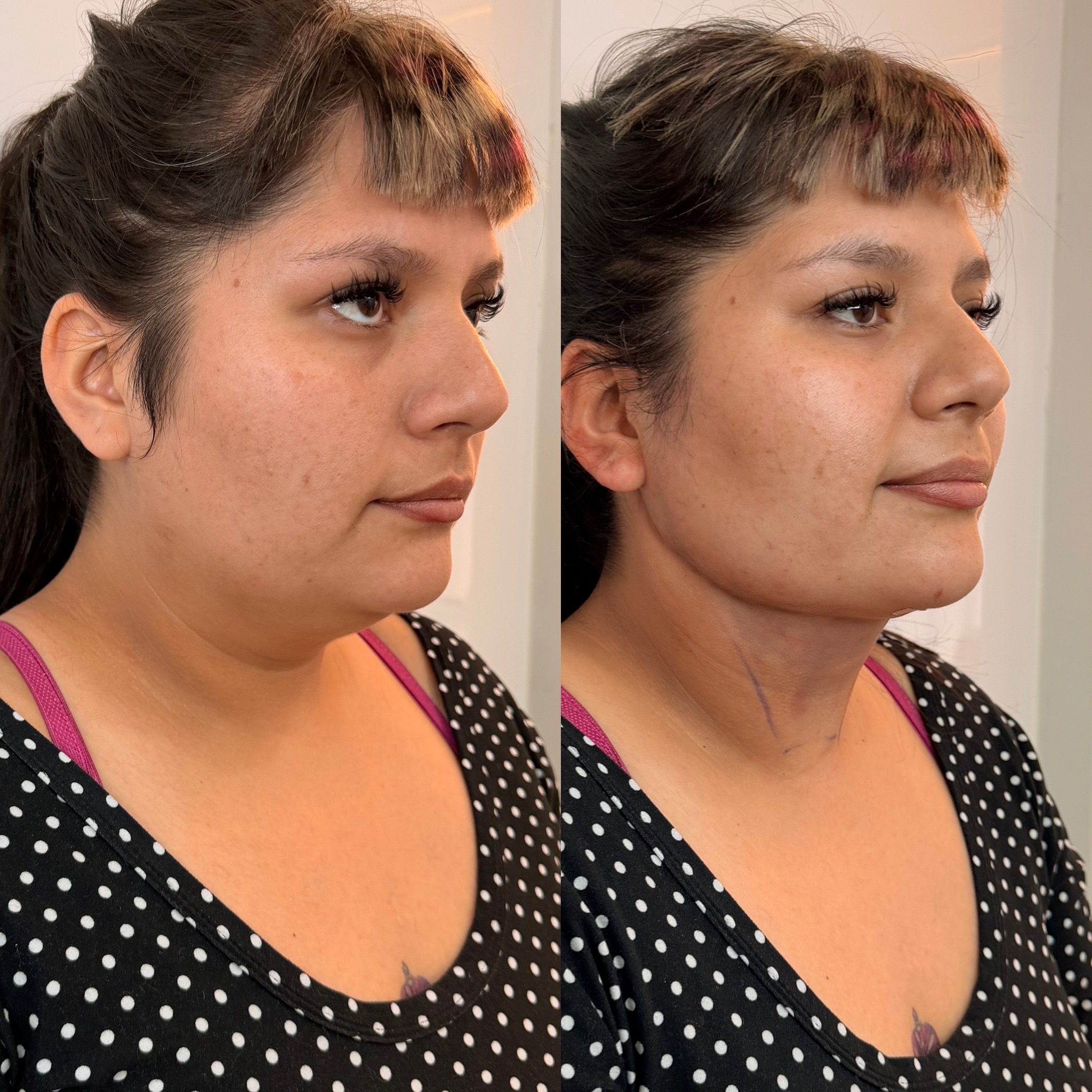 Antes y después Mini Lifting - Caso 2