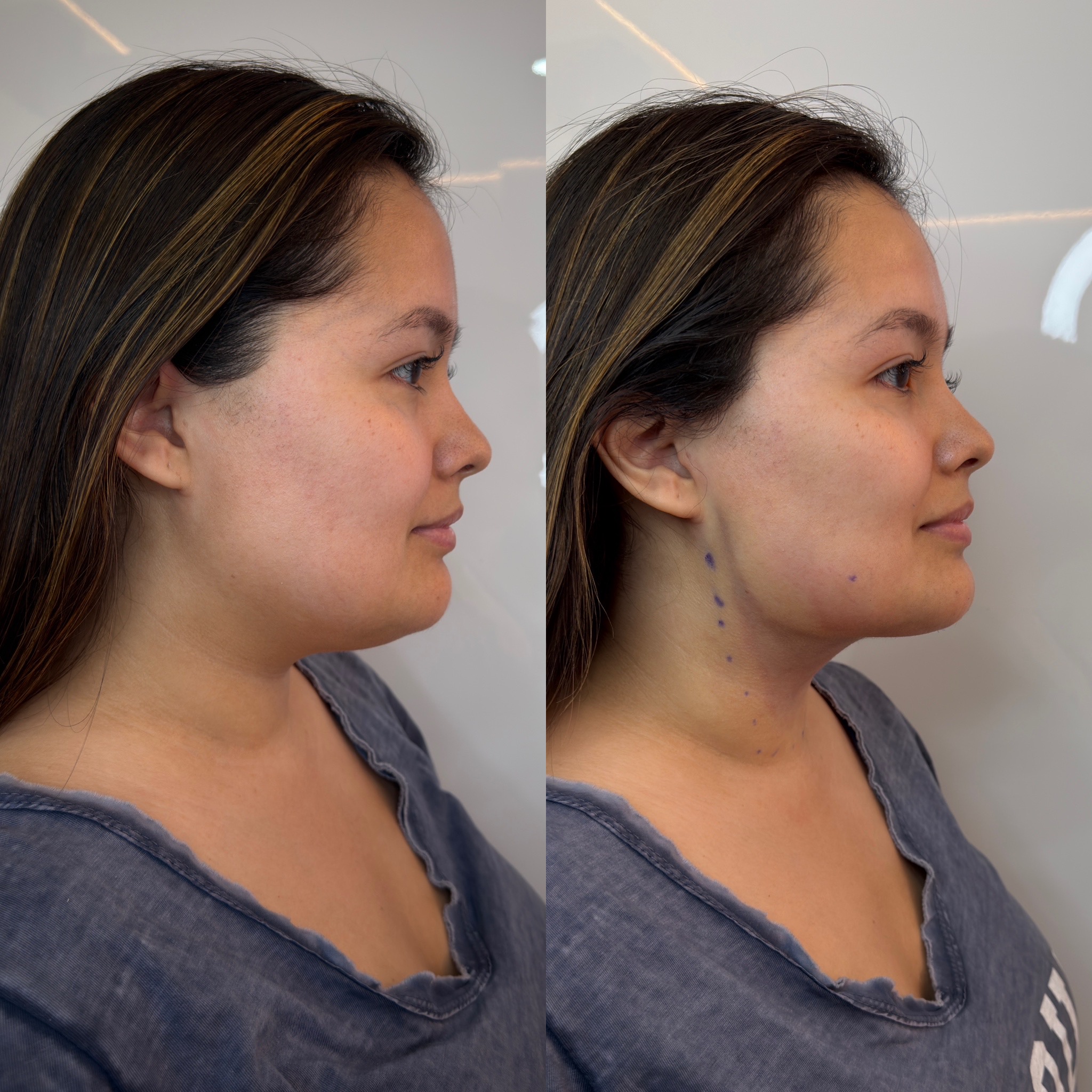 Antes y después Mini Lifting - Caso 4