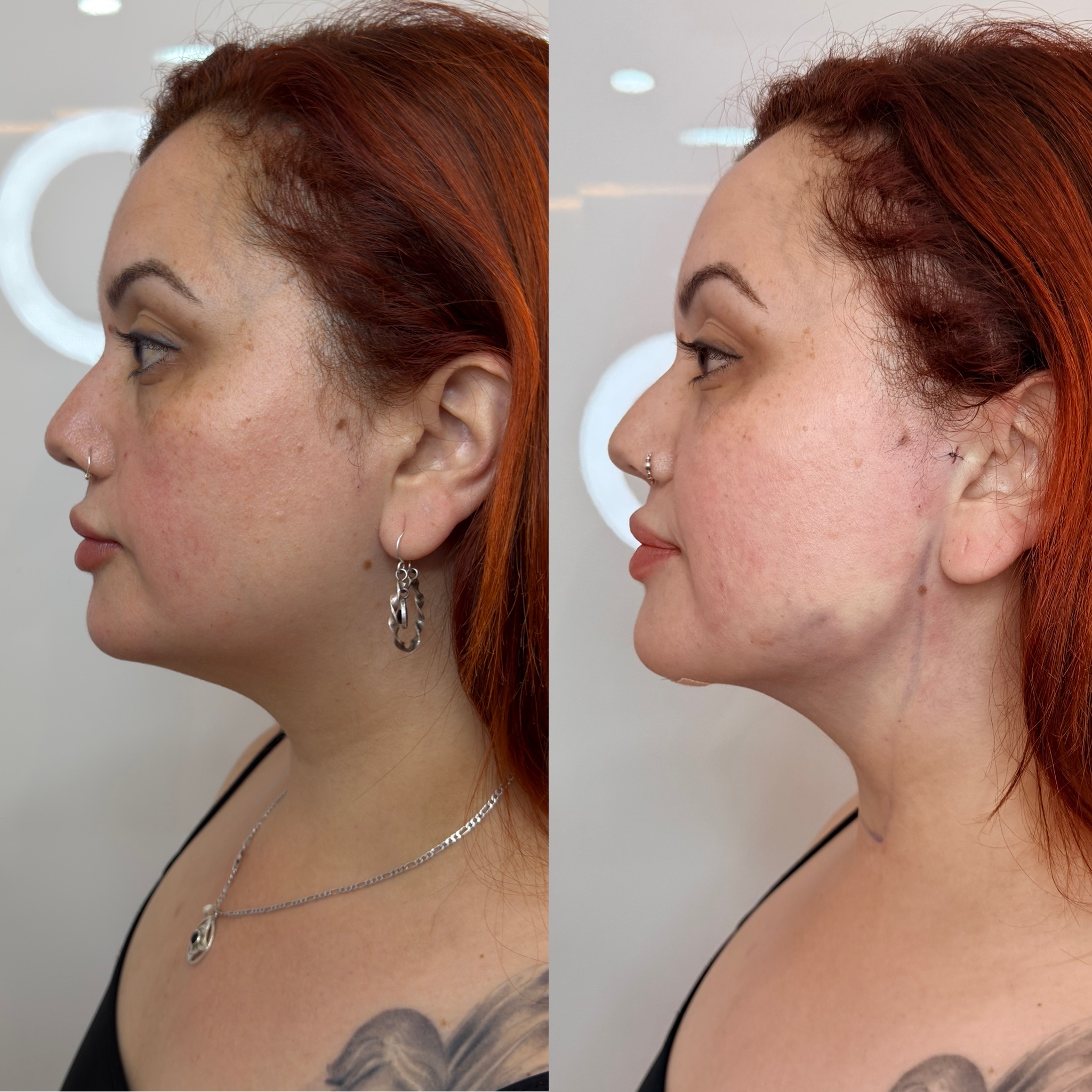 Antes y después Mini Lifting - Caso 1