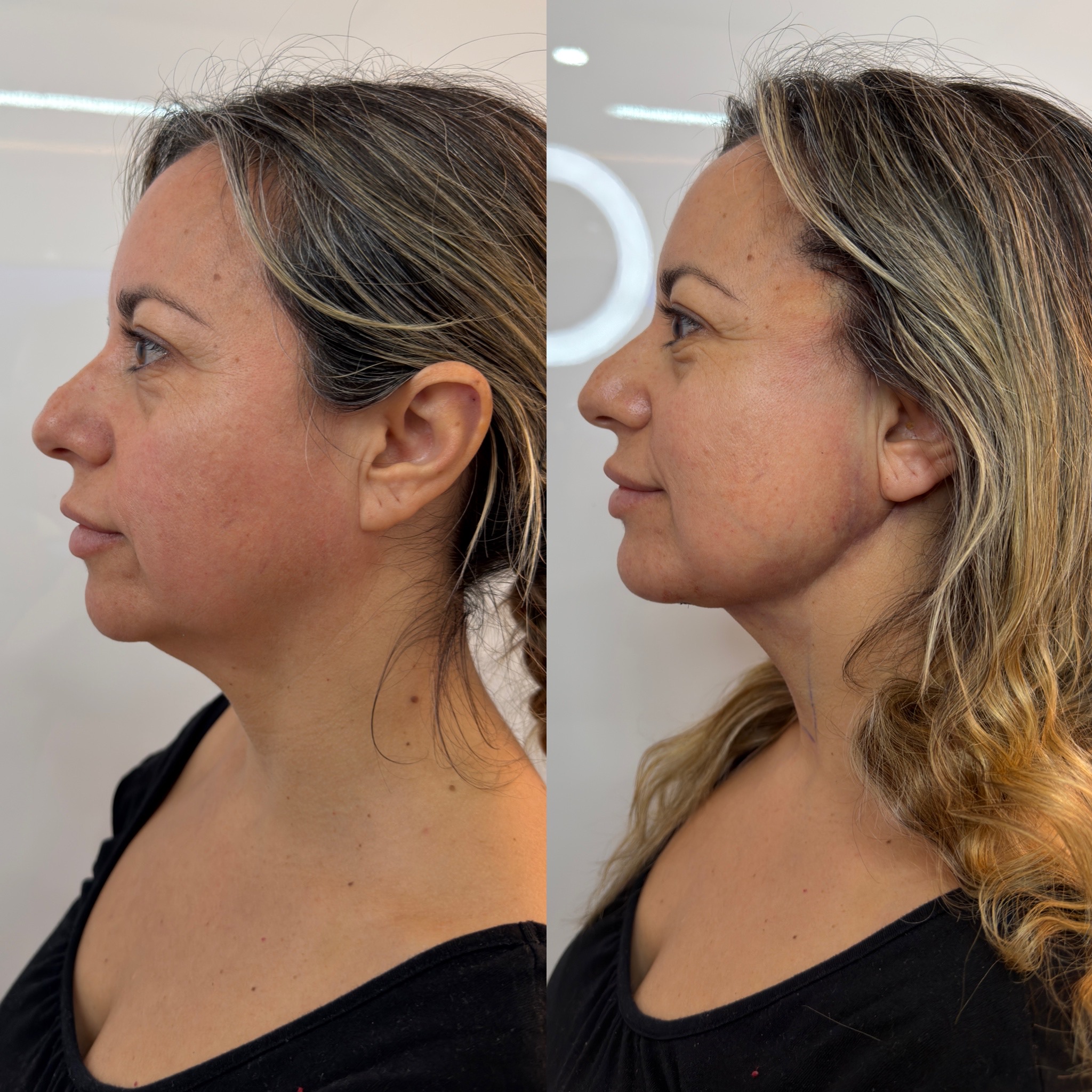 Antes y después Mini Lifting - Caso 3