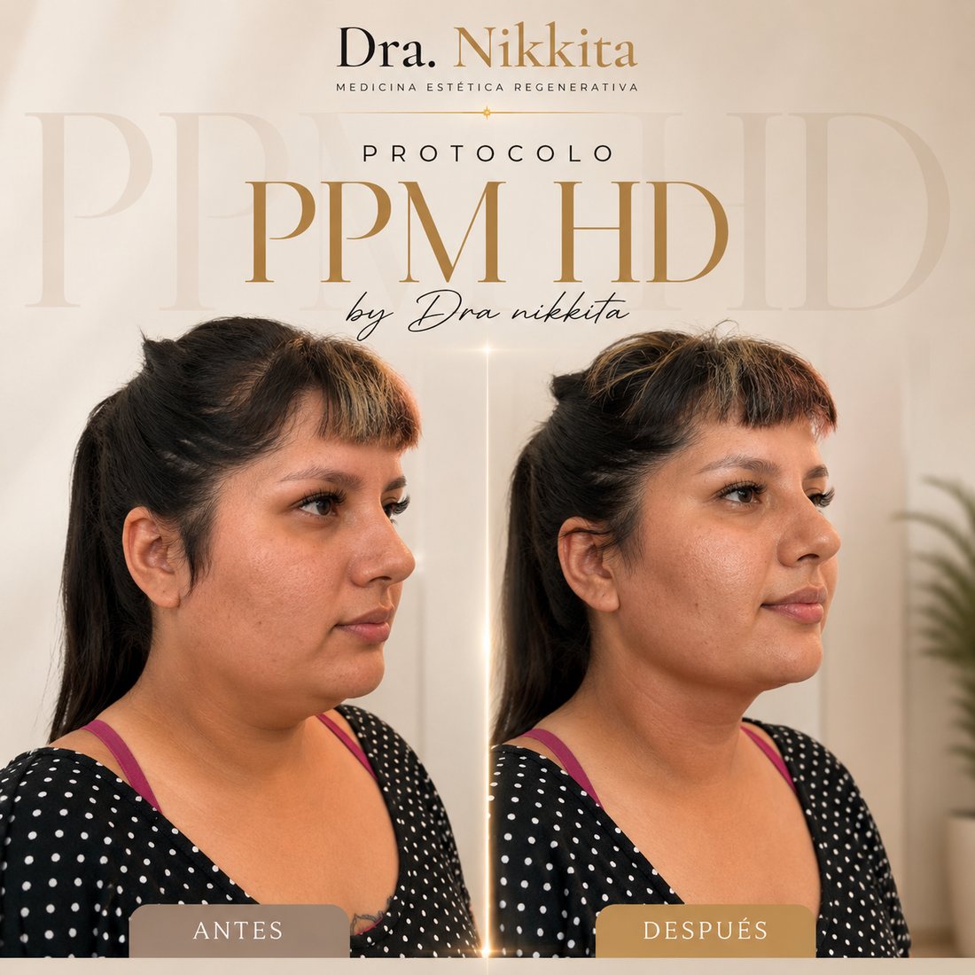 Resultado de tratamiento estético con la Dra. Nikkita, caso 2