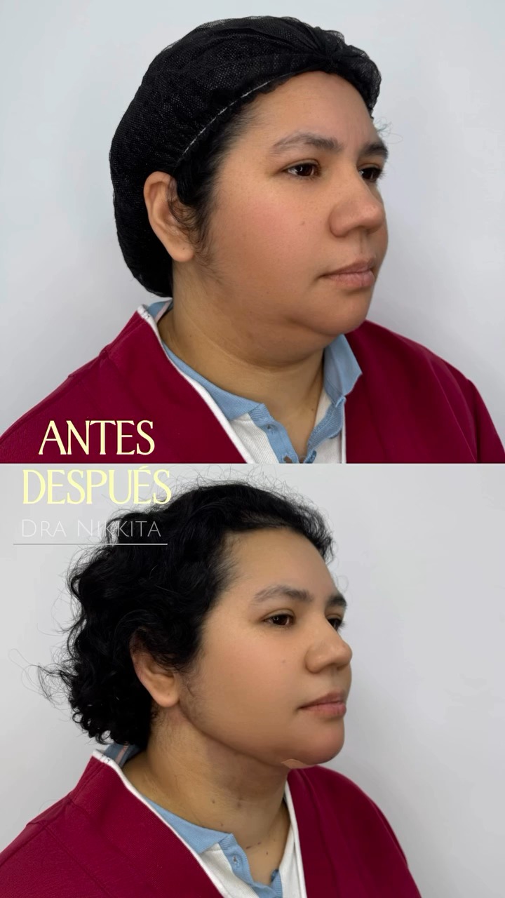 Fotograma del reel publicado por @dranikkita: María en tres cuartos, arriba rotulada «antes» con gorro quirúrgico y abajo «después» del Mini Lifting, con la línea del cuello más marcada.