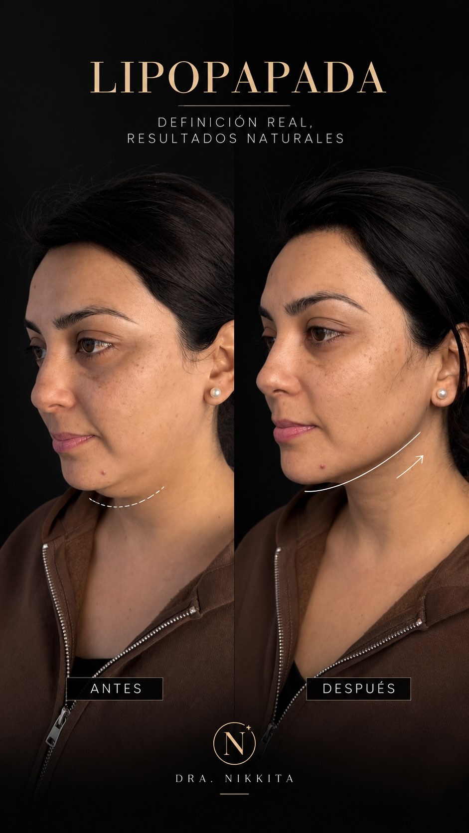 Pieza publicada del caso de Noemí: sus dos perfiles, antes y después de la Lipopapada HD, con el contorno mandibular marcado.