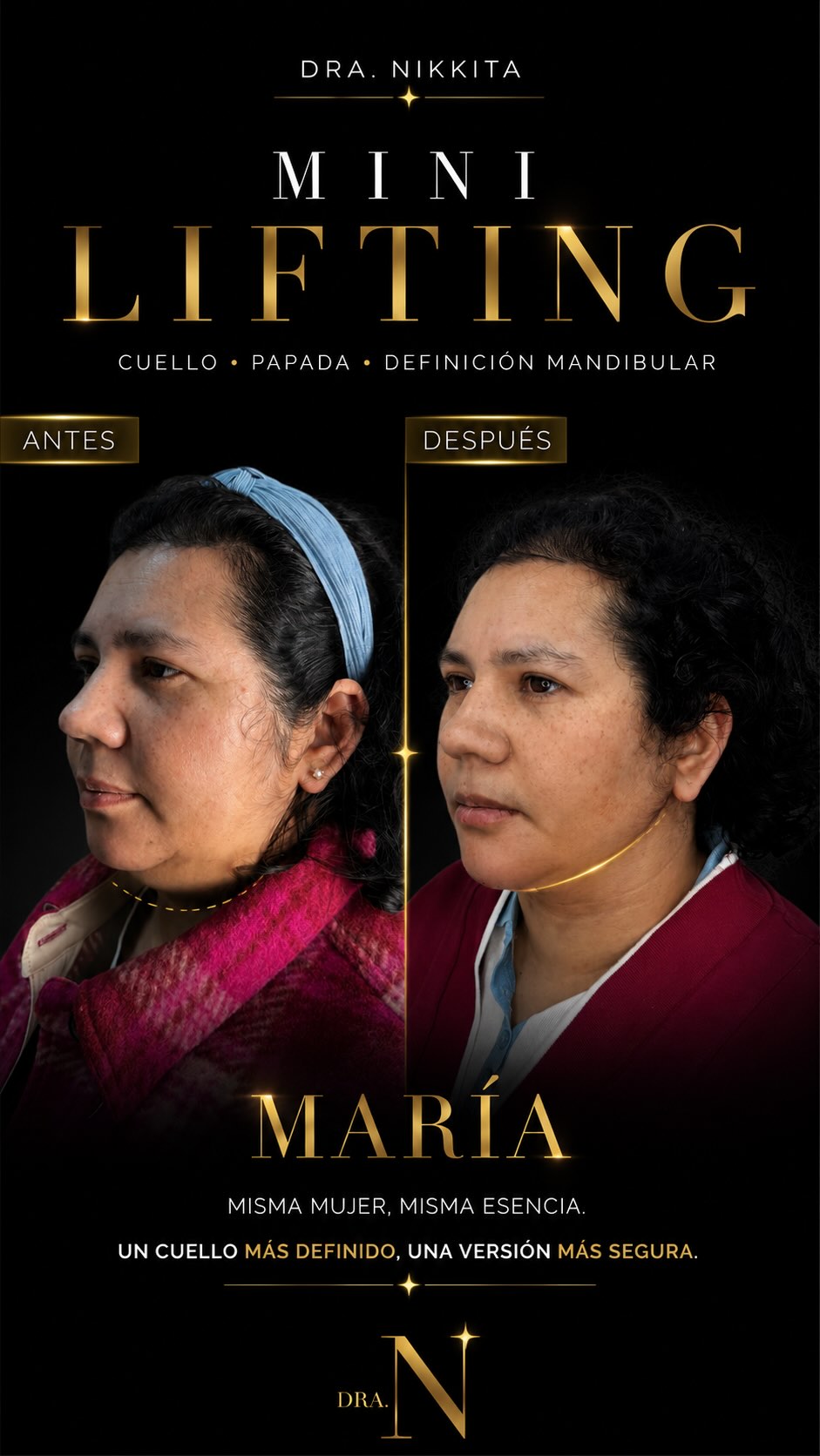 Pieza publicada del caso de María: sus dos perfiles, antes y después del Mini Lifting, con la línea mandibular marcada.